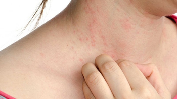 Bệnh nào dễ mắc trong mùa xuân?