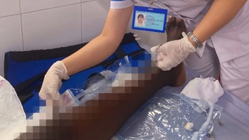Phẫu thuật thành công cho người Nigeria bị gãy lún mâm chày nhập viện muộn 3 tuần