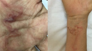 Ghi nhận ca bệnh 'giun rồng' ở Việt Nam, loại giun dài đến hàng mét
