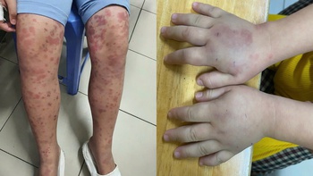Cảnh báo bệnh ban xuất huyết Schonlein - Henoch gây biến chứng thận nguy hiểm ở trẻ em