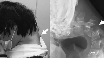 Thanh niên 25 tuổi mắc 'hội chứng cúi đầu' do nhìn điện thoại quá nhiều