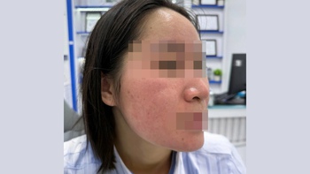 Hết trị bách bệnh, lại rước họa vì dùng nước cốt chanh trị mụn