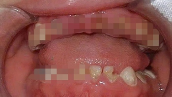 Những ảnh hưởng tới răng, xương hàm, gia đình có trẻ bú bình cần biết