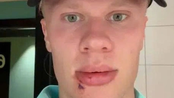 Erling Haaland khâu 3 mũi sau tai nạn hy hữu