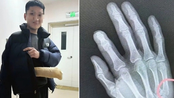 Kèm con học bài, bố nhập viện vì gãy tay sau cú đập bàn