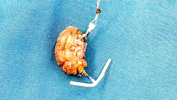 Lấy được vòng tránh thai nhiều sỏi bám do ‘đi lạc’ vào bàng quang sau 22 năm đặt