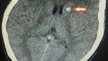 Mông, đùi chảy mủ sau khi tiêm chất làm đầy