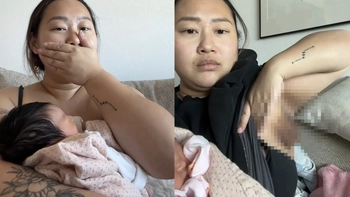 Người phụ nữ sau sinh 'mọc' thêm bầu ngực thứ ba ở nách