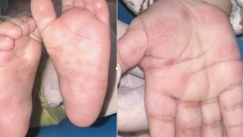 Bé trai gần 3 tuổi mắc giang mai dù không có triệu chứng