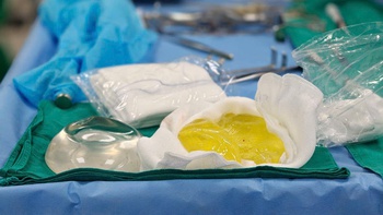 Phát hiện túi ngực vỡ vụn sau 5 năm: Bác sĩ cảnh báo biến chứng âm thầm dễ bỏ qua