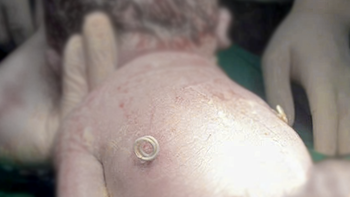 Em bé sinh ra với ‘đôi cánh nhỏ’ trên lưng