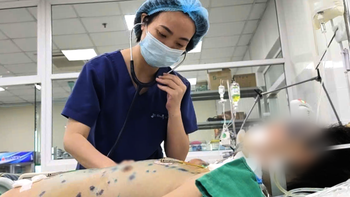 Cẩn trọng thủy đậu gây suy đa tạng, nguy hiểm tính mạng  ở người lớn