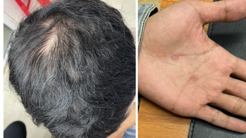 Lo ngại tóc rụng, tóc mỏng, yếu, nhưng bạn có biết loại trái cây giàu dinh dưỡng có lợi cho tóc?