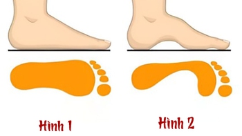 Quiz: Hình dạng vòm bàn chân tiết lộ gì về con người bạn?