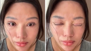 Người phụ nữ không thể nhắm kín mắt suốt 6 năm