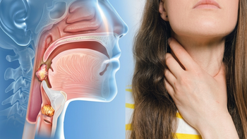 Triệu chứng ung thư vòm họng dễ nhầm với viêm họng, viêm xoang