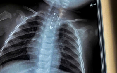 Cứu sống hai em bé nuốt kim băng và cây kẹo mút