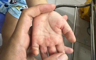 Báo động trẻ tử vong vì bệnh tay chân miệng tăng nhanh