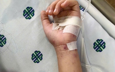 TP.HCM: Bé hơn 2 tuổi tử vong do viêm màng não mô cầu thể tối cấp, diễn tiến rất nhanh