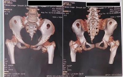 Bé gái 12 tuổi mắc hội chứng người hóa đá cực hiếm