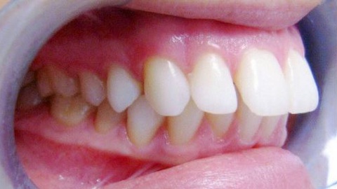 Khỏe đẹp cùng chuyên gia: Răng hô và hướng khắc phục - phần 2