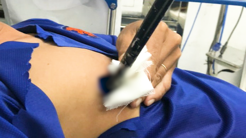 Video: Bị chĩa đâm thủng phổi và gan khi đi săn chuột