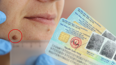 Xóa nốt ruồi thì có phải làm lại CCCD không?
