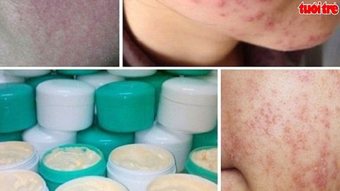 Rước họa vì làm đẹp bằng “kem trộn” chứa Coticoid