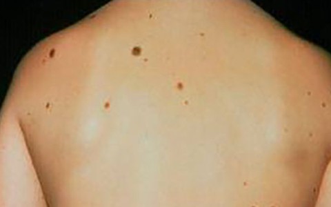 Đừng coi thường nốt ruồi, mụn cóc
