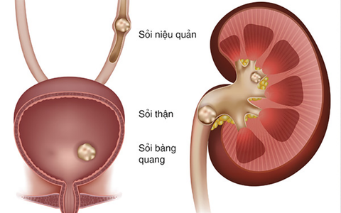Vì sao Việt Nam được xem là 'vùng sỏi thế giới'?