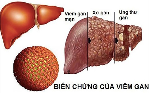 Xơi thực phẩm đường phố, coi chừng rước siêu vi viêm gan A