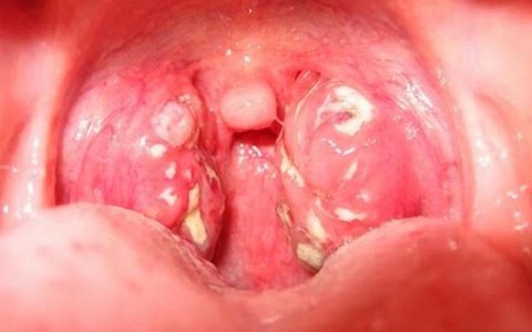 Bị viêm amiđan sao 'dập' kháng sinh 3 tuần mà vẫn không hết?