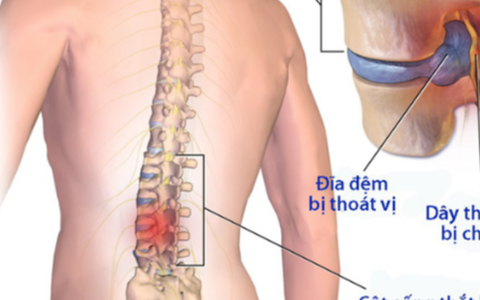 30% người Việt bị thoát vị đĩa đệm cột sống thắt lưng mà không biết