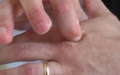 3 cách bấm huyệt đơn giản giảm cơn đau do thoái hóa đốt sống cổ