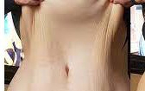 Da lỏng lẻo sau giảm cân, làm sao phục hồi?
