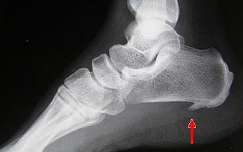 Phòng bệnh gai gót chân bằng cách nào?