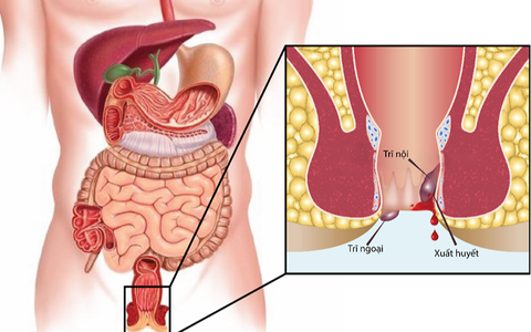 Đi cầu có máu, có phải bệnh trĩ?