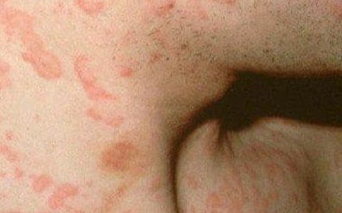 Những biện pháp vàng để tránh nổi mề đay