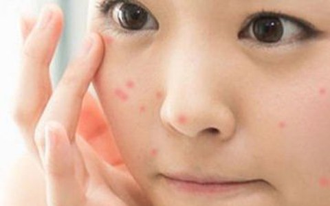 Bị mụn bọc, mụn mủ đồng loạt tổng tấn công, làm sao?