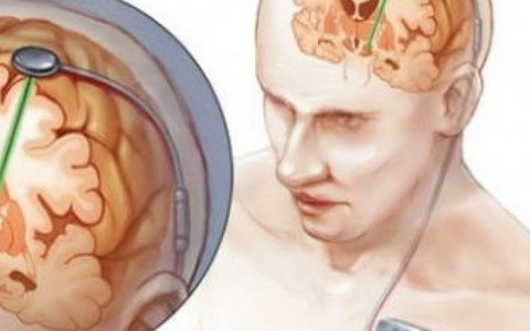 Kích thích não sâu để điều trị bệnh Parkinson