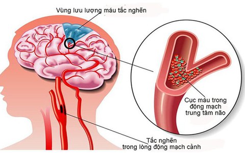 Hoạt huyết dưỡng não: Không nên ngộ nhận