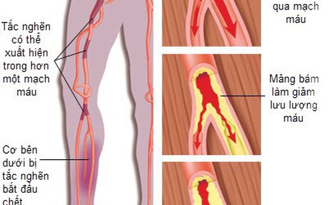 Tắc động mạch ngoại biên: âm thầm nhưng nguy hiểm