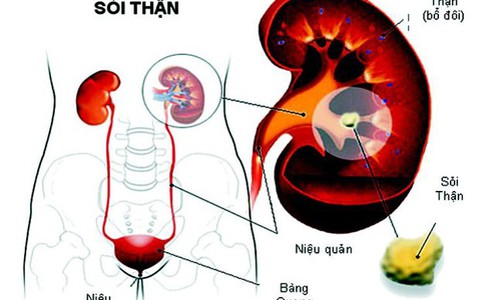 Biến chứng sỏi thận