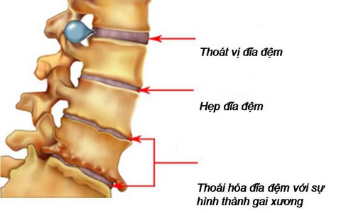 Thoái hóa cột sống ở người già và cách chữa