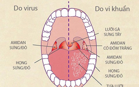 Bệnh viêm họng mùa lạnh