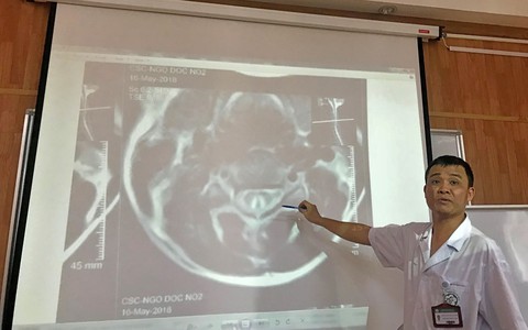 Tổn thương tủy sống vì bóng cười