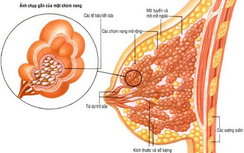 Bướu ở ngực, chưa chắc là ung thư