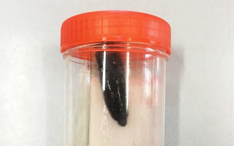 Con đỉa 5cm sống hai tháng trong đường thở bé gái