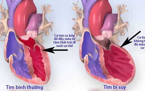 Những cách để phòng tránh suy tim