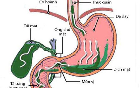 Trào ngược dịch mật